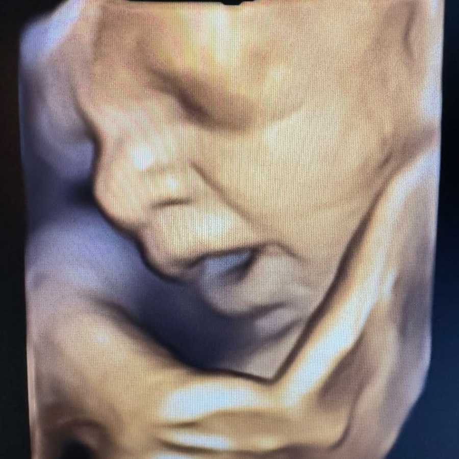 Ultrasound Image Gallery at Beautiful Beginnings Ultrasound Clinic in Shrewsbury, NJ