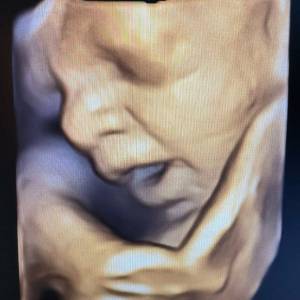 Ultrasound Image Gallery at Beautiful Beginnings Ultrasound Clinic in Shrewsbury, NJ