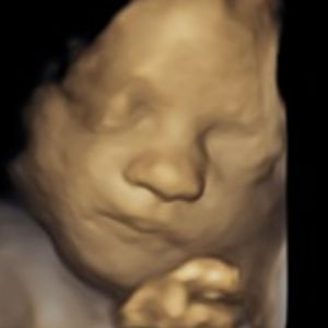 Ultrasound Image Gallery at Beautiful Beginnings Ultrasound Clinic in Shrewsbury, NJ