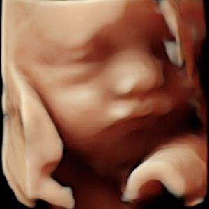 Ultrasound Image Gallery at Beautiful Beginnings Ultrasound Clinic in Shrewsbury, NJ